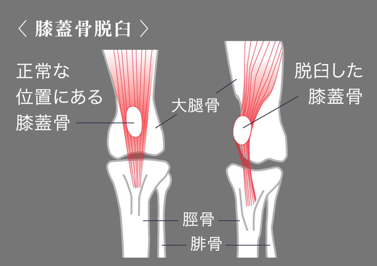 膝蓋骨脱臼